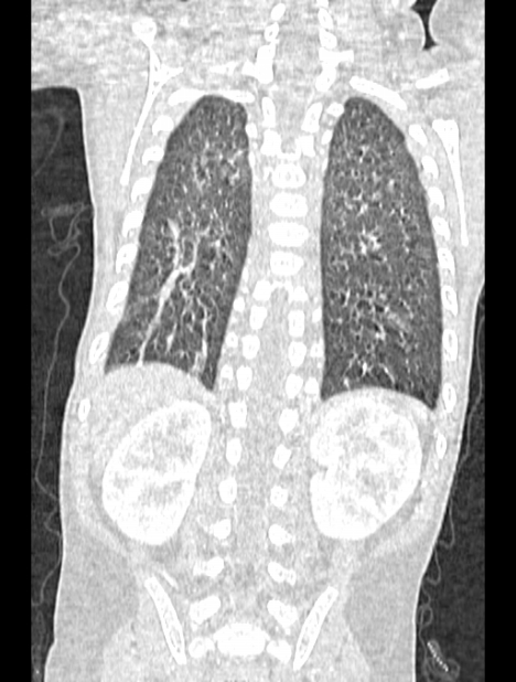 Asplenia syndrome (Radiopaedia 73083-83792 Coronal lung window 110).jpg