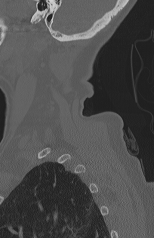 Atlanto-axial subluxation (Radiopaedia 36610-38176 Sagittal bone window 13).png