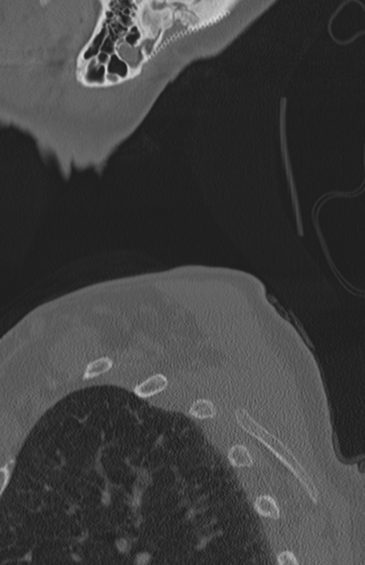 Atlanto-axial subluxation (Radiopaedia 36610-38176 Sagittal bone window 78).png
