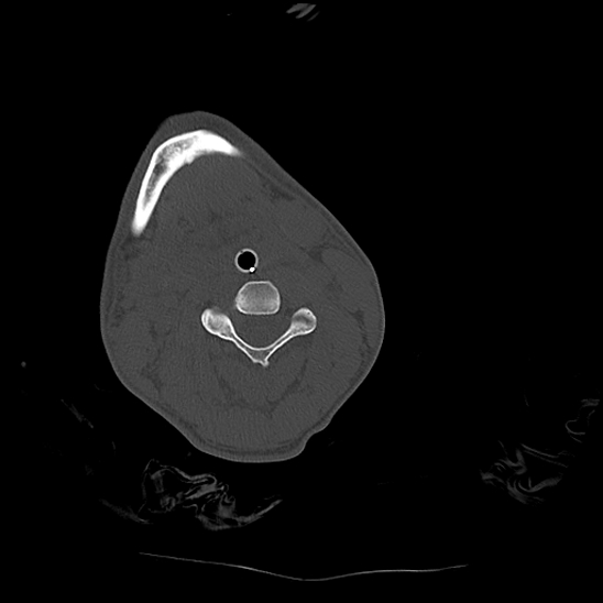 Atlanto-occipital dissociation (Traynelis type 1), C2 teardrop fracture, C6-7 facet joint dislocation (Radiopaedia 87655-104061 Axial bone window 43).jpg