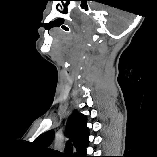 Atlanto-occipital dissociation (Traynelis type 1), C2 teardrop fracture, C6-7 facet joint dislocation (Radiopaedia 87655-104061 D 33).jpg