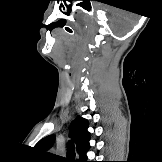 Atlanto-occipital dissociation (Traynelis type 1), C2 teardrop fracture, C6-7 facet joint dislocation (Radiopaedia 87655-104061 D 34).jpg