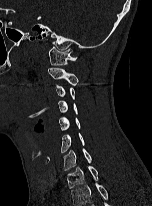 Atlantoaxial subluxation (Radiopaedia 44681-48450 Sagittal bone window 116).jpg