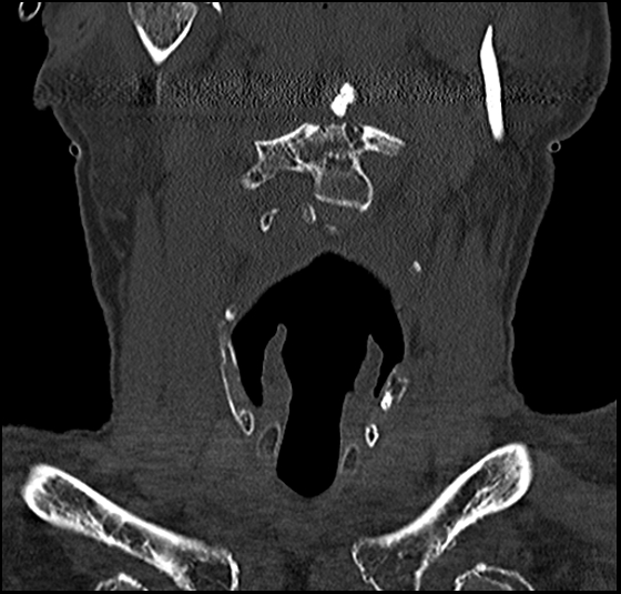 File:Atlas (type 3b subtype 1) and axis (Anderson and D'Alonzo type 3, Roy-Camille type 2) fractures (Radiopaedia 88043-104607 Coronal bone window 15).jpg