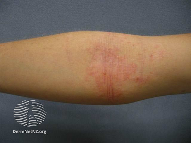File:Atopic dermatitis (DermNet NZ dermatitis-flexural-eczema01).jpg