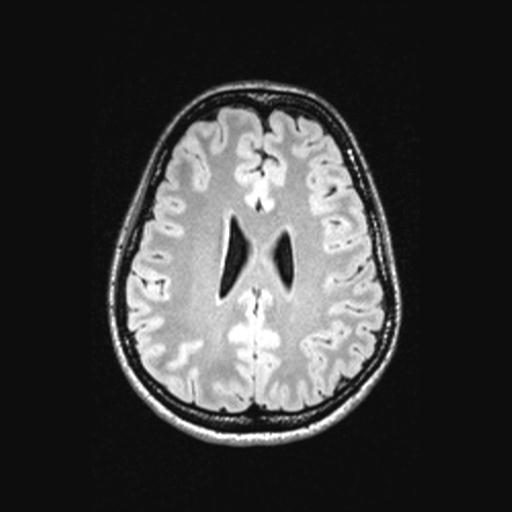 Atretic encephalocoele with inferior vermis hypoplasia (Radiopaedia 30443-31108 Axial 105).jpg