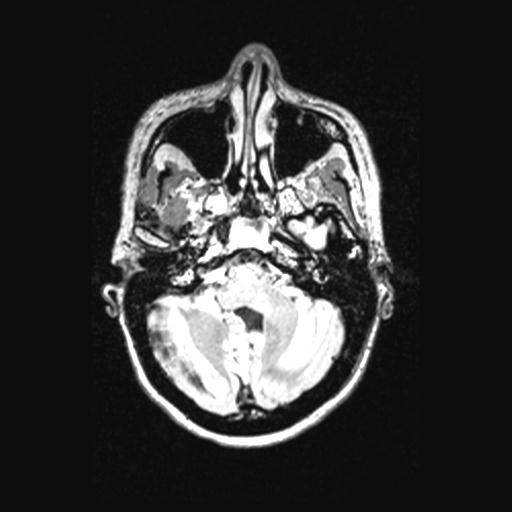 Atretic encephalocoele with inferior vermis hypoplasia (Radiopaedia 30443-31108 Axial 41).jpg