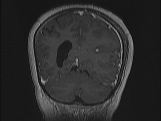 Atypical meningioma (Radiopaedia 62985-71406 Coronal T1 C+ 96).jpg