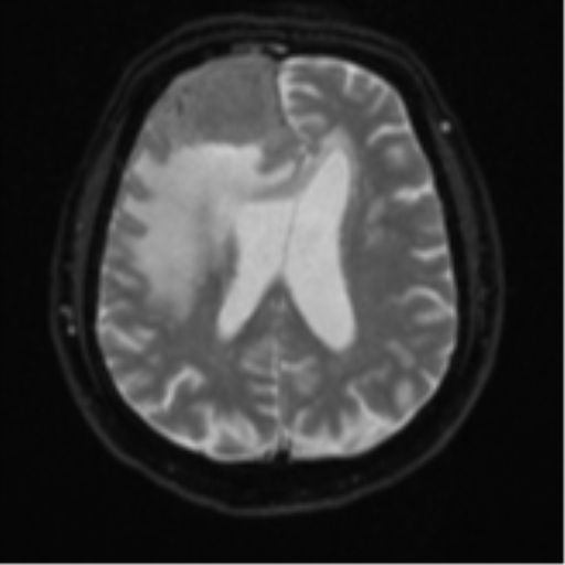 Atypical meningioma (WHO grade II) with brain invasion (Radiopaedia 57767-64729 Axial DWI 19).png