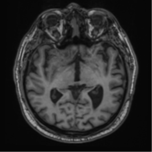 File:Atypical meningioma (WHO grade II) with brain invasion (Radiopaedia 57767-64729 Axial T1 22).png