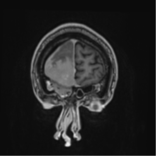File:Atypical meningioma (WHO grade II) with brain invasion (Radiopaedia 57767-64729 Coronal T1 C+ 4).png