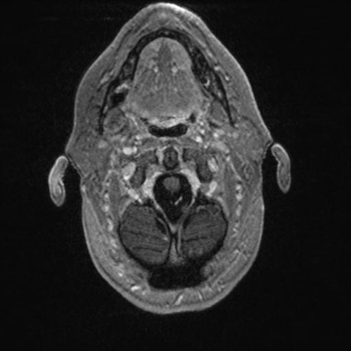 Atypical meningioma (grade II) - en plaque (Radiopaedia 29633-30147 Axial T1 C+ 20).jpg
