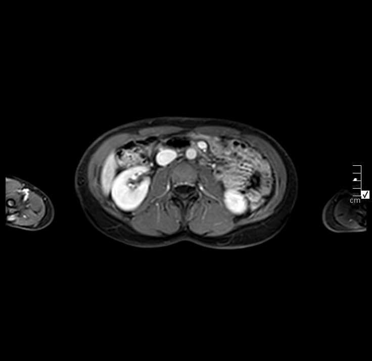 Autoimmune pancreatitis (Radiopaedia 40166-42675 Axial venous phase 15).JPG