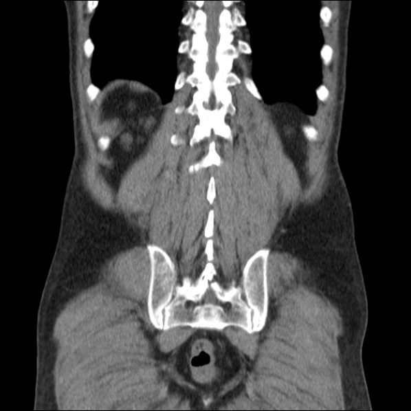 Autosomal dominant polycystic kidney disease (Radiopaedia 36539-38101 C 57).jpg