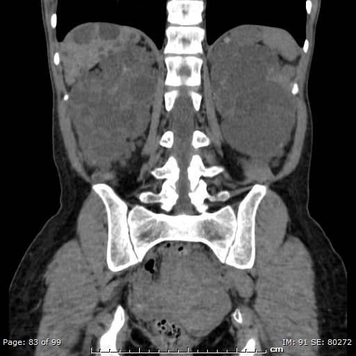 File:Autosomal dominant polycystic kidney disease (Radiopaedia 44122-47684 Coronal 22).jpg