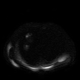 Autosomal dominant polycystic kidney disease (Radiopaedia 50259-55611 Axial DWI 37).jpg