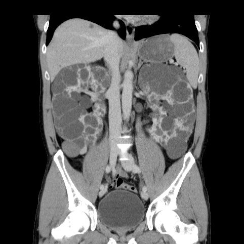 Autosomal dominant polycystic kidney disease (Radiopaedia 66349-75582 A 44).jpg