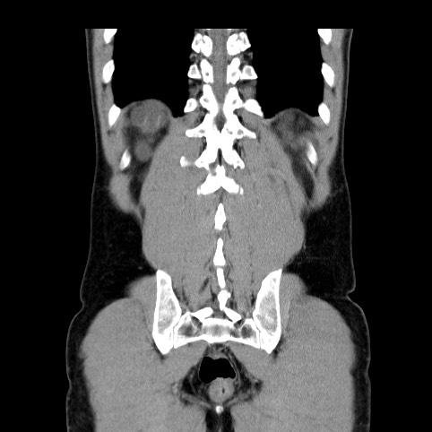 File:Autosomal dominant polycystic kidney disease (Radiopaedia 66349-75582 A 79).jpg