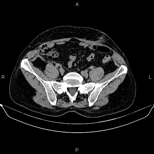 Autosomal dominant polycystic kidney disease (Radiopaedia 87830-104287 Axial non-contrast 41).jpg