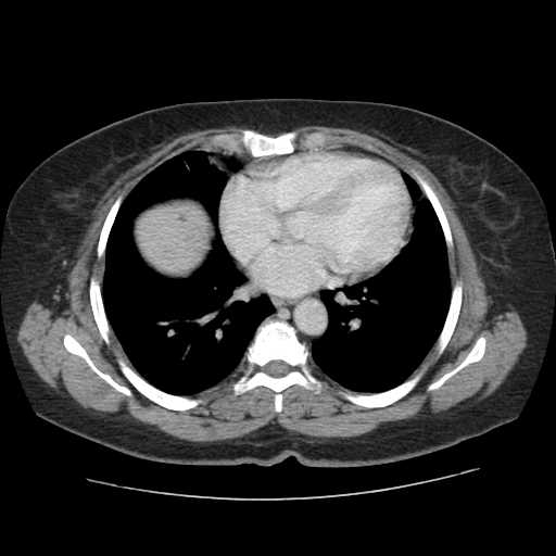File:Autosomal dominant polycystic kidney disease with hepatic involvement (Radiopaedia 32693-33662 B 3).jpg
