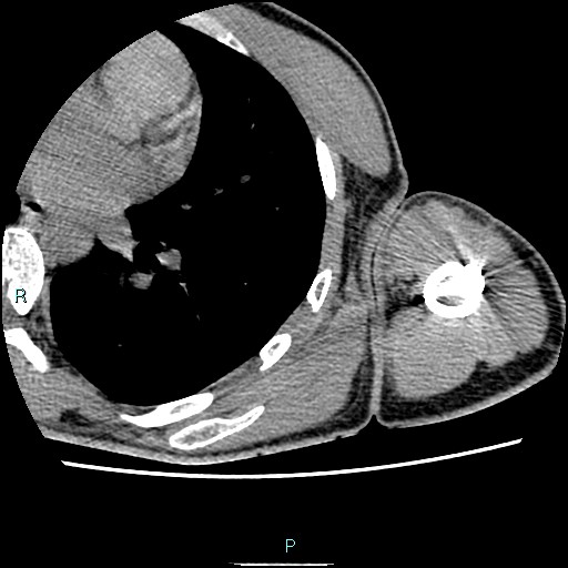 File:Avascular necrosis after fracture dislocations of the proximal humerus (Radiopaedia 88078-104653 D 81).jpg