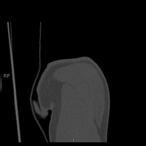 Avascular necrosis after fracture dislocations of the proximal humerus (Radiopaedia 88078-104655 Coronal bone window 29).jpg