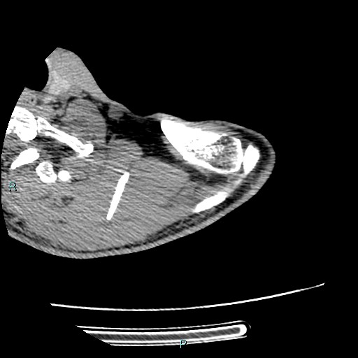 Avascular necrosis after fracture dislocations of the proximal humerus (Radiopaedia 88078-104655 D 25).jpg