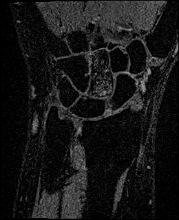 Avascular necrosis of the capitate (Radiopaedia 88317-104948 Coronal T1 vibe 42).jpg