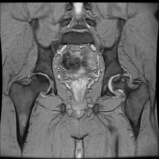 Avascular necrosis of the hip (Radiopaedia 61503-69465 F 59).jpg