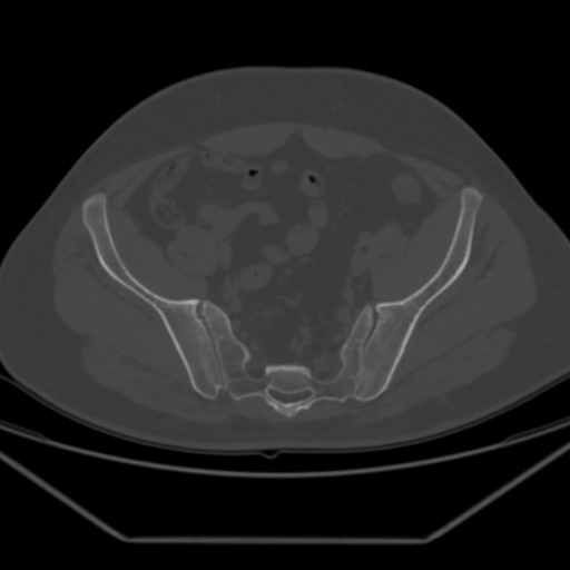 File:Avascular necrosis of the hip (Radiopaedia 61503-69467 Axial bone window 15).jpg