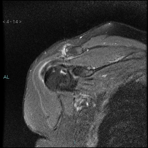 File:Avascular necrosis of the shoulder - Cruess stage I (Radiopaedia 77674-89886 Coronal PD fat sat 14).jpg
