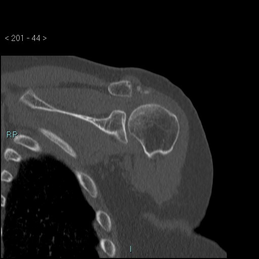 Avascular necrosis of the shoulder - Cruess stage I (Radiopaedia 77674-89887 Coronal bone window 43).jpg