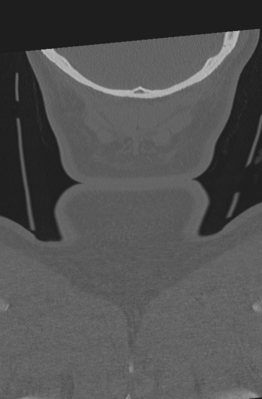 Axis peg fracture (type 3) and atlas lateral mass (type 4) fracture (Radiopaedia 37474-39324 Coronal bone window 70).png