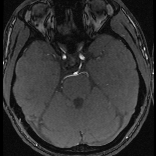 Azygos anterior cerebral artery (Radiopaedia 17059-16756 Axial MRA 52).jpg