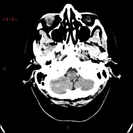 Azygos anterior cerebral artery (Radiopaedia 51987-57833 A 9).jpg