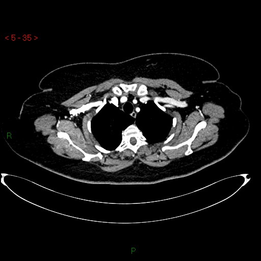 Azygos fissure and lobe (Radiopaedia 47620-52278 A 21).jpg