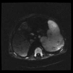 B cell lymphoma (Radiopaedia 56281-62954 Axial DWI 52).jpg
