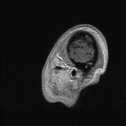 Balo concentric sclerosis (Radiopaedia 50458-55940 Sagittal T1 C+ 141).jpg