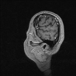 Balo concentric sclerosis (Radiopaedia 50458-55940 Sagittal T1 C+ 21).jpg
