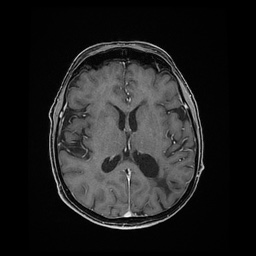 Balo concentric sclerosis (Radiopaedia 53875-59982 Axial LAVA C+ 146).jpg