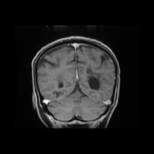 Balo concentric sclerosis (Radiopaedia 53875-59982 Coronal LAVA C+ 17).jpg