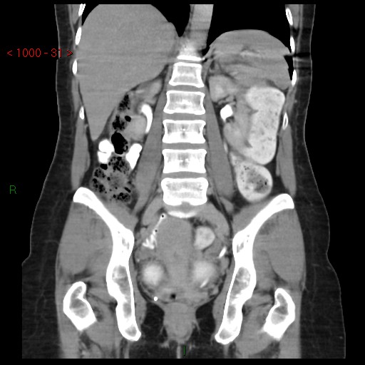 File:Bartholin gland cyst (Radiopaedia 54904-61181 Coronal C+ delayed 31).jpg