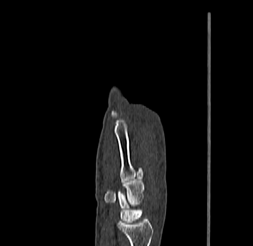 Base of 2nd metacarpal fracture (Radiopaedia 73741-84544 Sagittal bone window 34).jpg