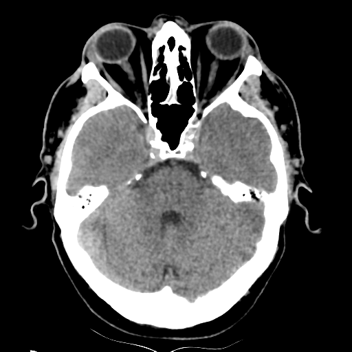 File:Basilar artery occlusion (Radiopaedia 33570-34659 Axial non-contrast 13).png