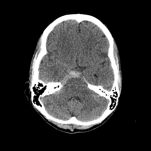 File:Basilar artery perforator aneurysm (Radiopaedia 82455-96597 Axial non-contrast 11).jpg
