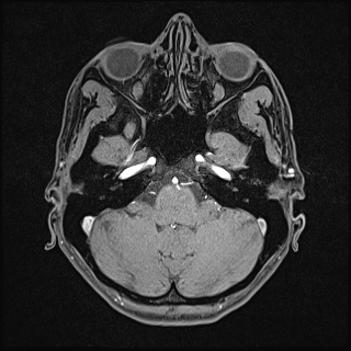 Basilar artery perforator aneurysm (Radiopaedia 82455-97733 Axial T1 fat sat 32).jpg