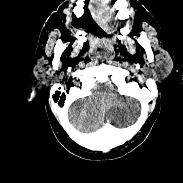 Basilar artery thrombosis (Radiopaedia 53351-59352 Axial non-contrast 20).jpg