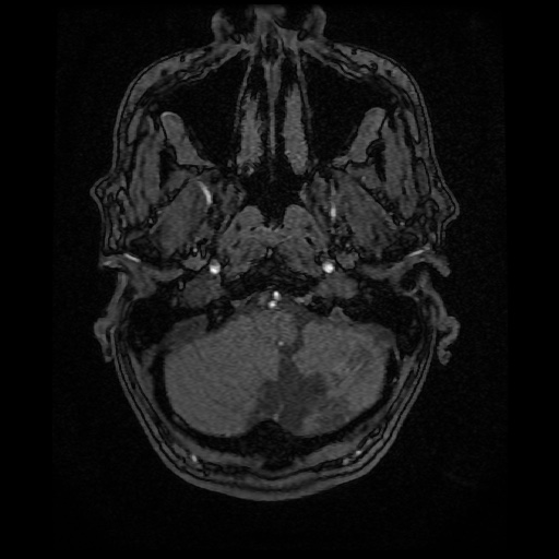 Basilar top and left middle cerebral artery aneurysm (Radiopaedia 61965-70031 Axial MRA 8).jpg