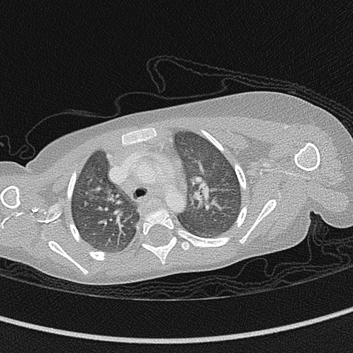 Beckwith-Wiedeman syndrome with bilateral Wilms tumors (Radiopaedia 60850-68629 Axial lung window 22).jpg