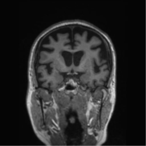 File:Behavioral variant frontotemporal dementia and late onset schizophrenia (Radiopaedia 52197-58083 Coronal T1 56).png